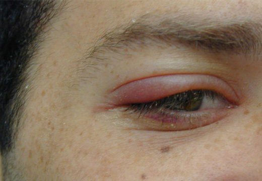 Как лечить чирей на глазу, лечение фурункула на глазу
