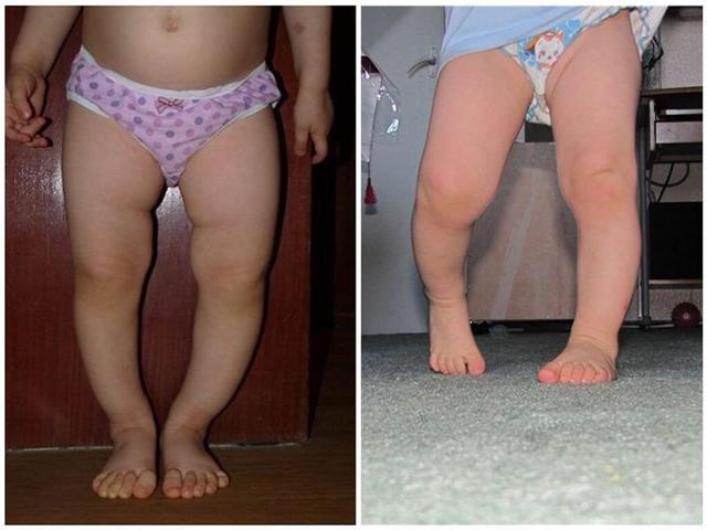 Как лечить деформацию стопы и голени у ребенка
