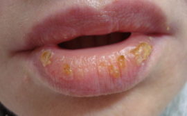 Как лечить хейлит на губах: эффективные препараты, народные методы, профилактические мероприятия