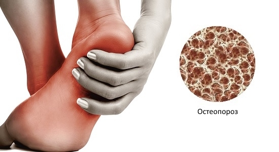 Как лечить остеопороз: виды лекарств, рекомендации по применению, побочные эффекты