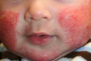 Как называется анализ на аллергию у детей