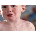 Как называется анализ на аллергию у детей