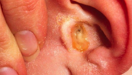 Как определить образование серной пробки в ухе: причины и способы лечения