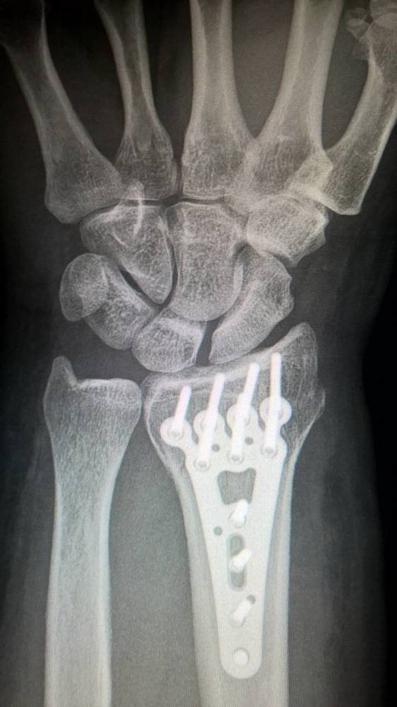 Как определить перелом ребра по рентгеновскому снимку: расшифровка рентгена