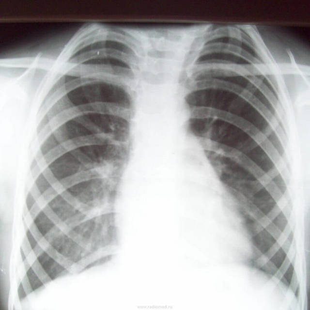 Как определить перелом ребра по рентгеновскому снимку: расшифровка рентгена