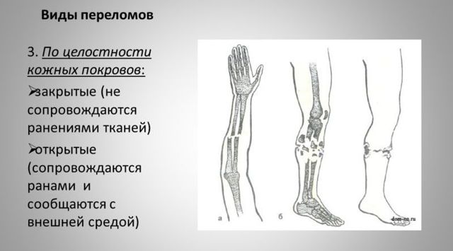 Как определить: ушиб или перелом