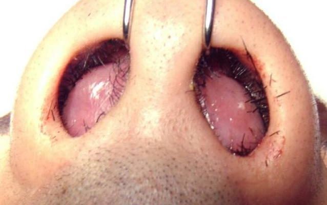 Как проявляется абсцесс носовой перегородки: симптомы и лечение