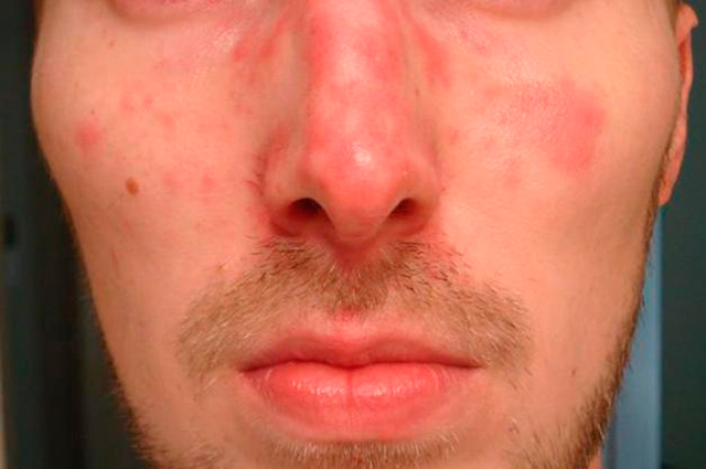 Как проявляется аллергия на алкоголь и отчего появляются красные пятна на лице