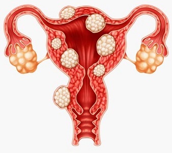 Как проявляется фибромиома матки: причины, диагностика и в чем опасность болезни?