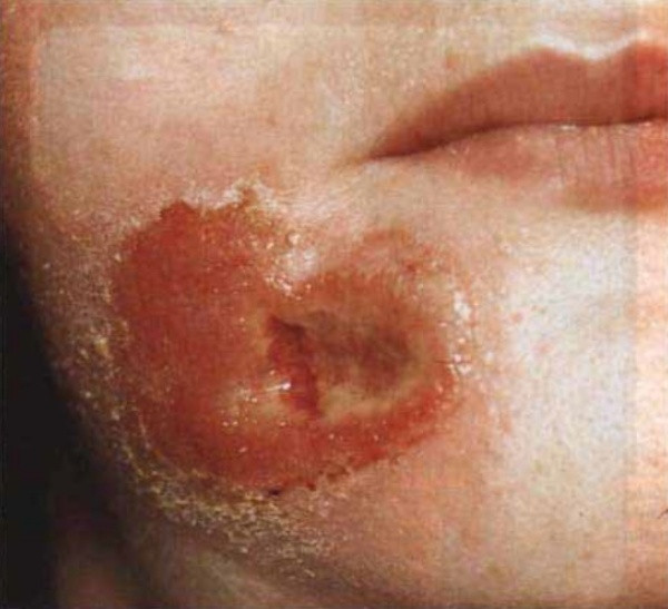 Как проявляется сифилис у женщин: симптомы, первые признаки сифилиса у женщин