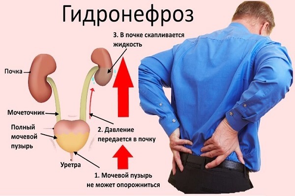 Как проявляется стриктура уретры у мужчин и женщин: симптомы сужения мочеиспускательного канала