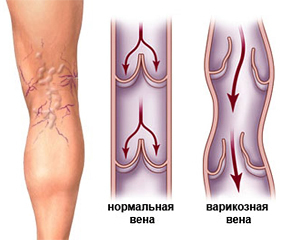 Как проявляется тромбоз и варикоз вен на ногах и руках, методы лечения заболеваний