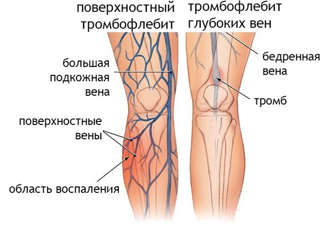 Как проявляется тромбоз и варикоз вен на ногах и руках, методы лечения заболеваний