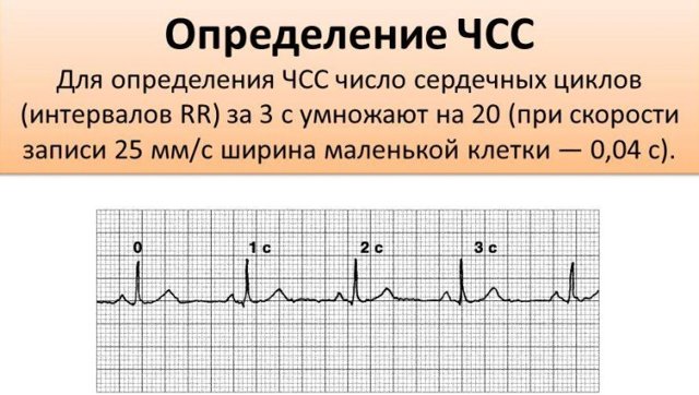 Как расшифровать экг сердца и диагностировать патологии сердца по экг