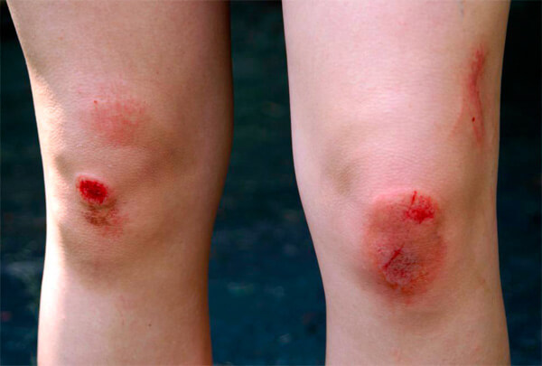 Как ускорить заживление раны на колене?
