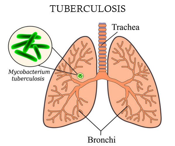 Какие первые признаки туберкулеза гортани и как диагностировать