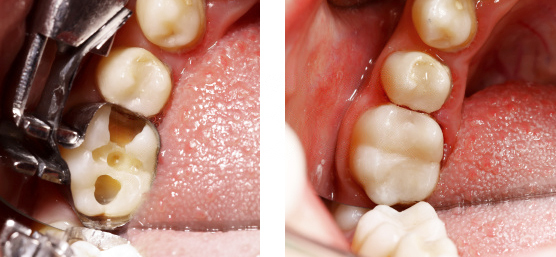 Какие пломбы лучше ставить на жевательные и передние зубы: сравнение пластмассовых и светоотверждаемых материалов