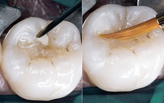 Какие пломбы лучше ставить на жевательные и передние зубы: сравнение пластмассовых и светоотверждаемых материалов