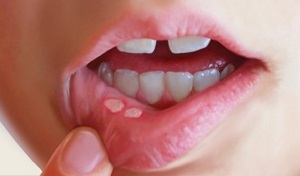 Какие причины появления язв во рту: рекомендации к лечению в домашних условиях,