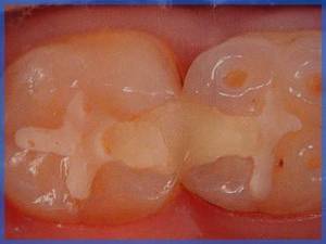 Какие считаются лучшими зубные пломбы: виды, преимущества и недостатки каждого