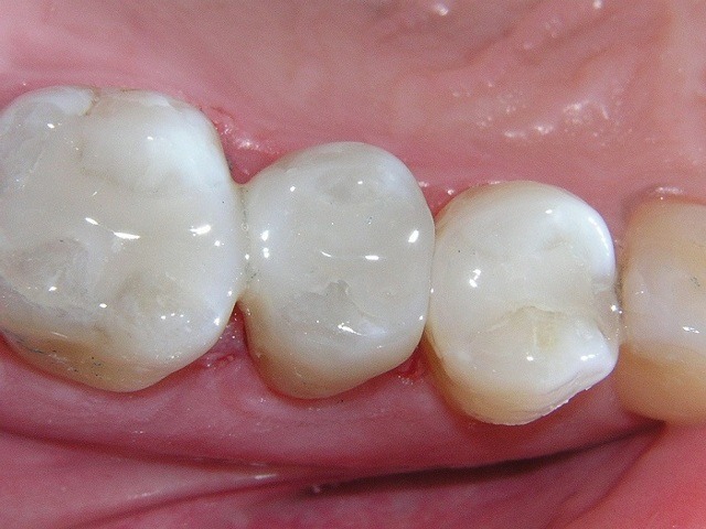 Какие считаются лучшими зубные пломбы: виды, преимущества и недостатки каждого