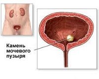 Камни в мочевом пузыре: симптомы и лечение у мужчин и женщин, меры профилактики и прогноз