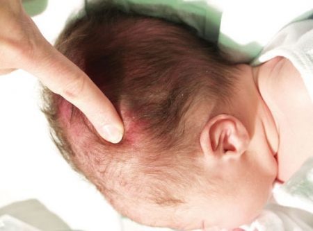 Кефалогематома у новорожденных: причины появления, характерные проявления, принципы лечения и возможные осложнения