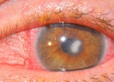Кератит глаза: что это такое, симптомы и лечение заболевания с подробными фото