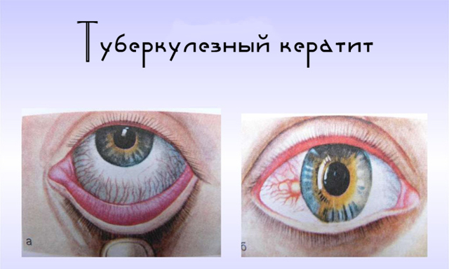 Кератит глаза: что это такое, симптомы и лечение заболевания с подробными фото