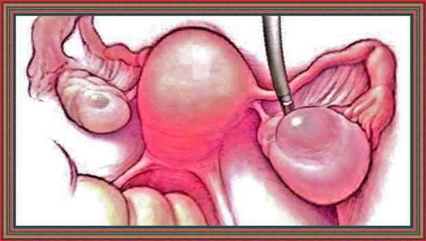 Киста яичника: первые признаки, способы диагностики и лечения 