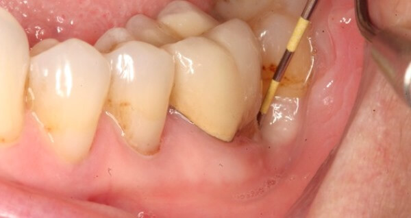 Киста зуба: что это такое, причины появления, методы лечения с подробными фото