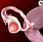Кистома яичника: группы риска, клиническая картина, методы лечения и возможные осложнения