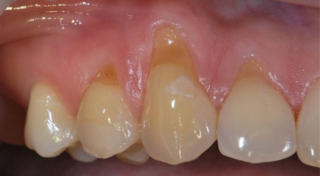 Клиновидный дефект зубов: откуда появляется проблема, симптомы и диагностика, методы лечения