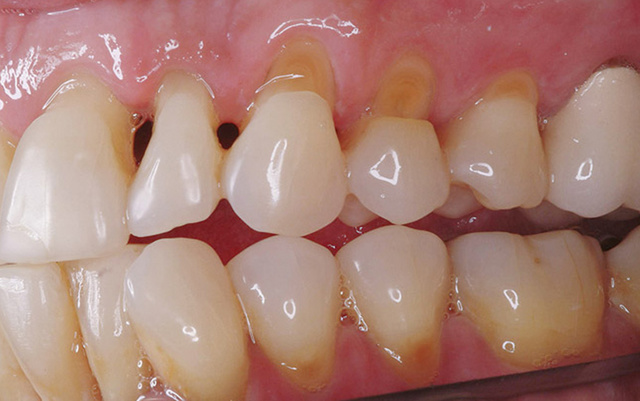 Клиновидный дефект зубов: откуда появляется проблема, симптомы и диагностика, методы лечения