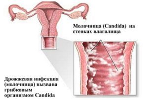 Клотримазол мазь: состав, показания и противопоказания, применение при молочнице у женщин