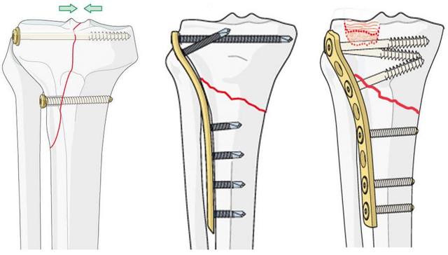 Когда удалять металлоконструкции после перелома берцовой кости?
