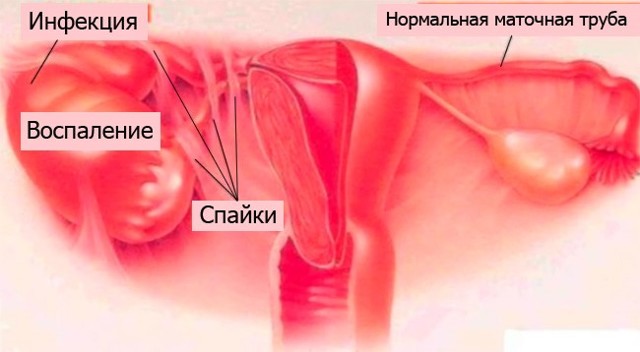 Колет в правом боку внизу живота у женщины, у мужчины: причины недуга, характеристика заболеваний, неотложная помощь