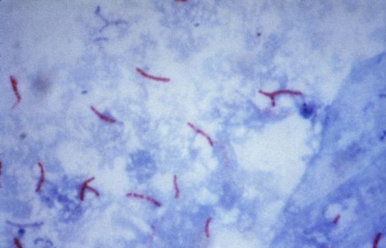 Колликвативный туберкулез кожи, скрофулодерма: что это и почему возникает, лечение и возможные осложнения