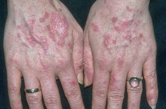 Колликвативный туберкулез кожи, скрофулодерма: что это и почему возникает, лечение и возможные осложнения