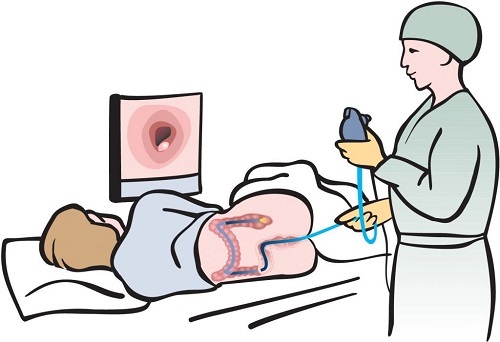 Колоноскопия: суть метода, показания и правила подготовки к процедуре