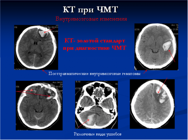 Компьютерная томография головного мозга: определение, показания и противопоказания, разновидности.