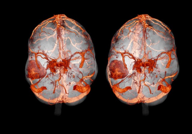 Компьютерная томография головного мозга: определение, показания и противопоказания, разновидности.