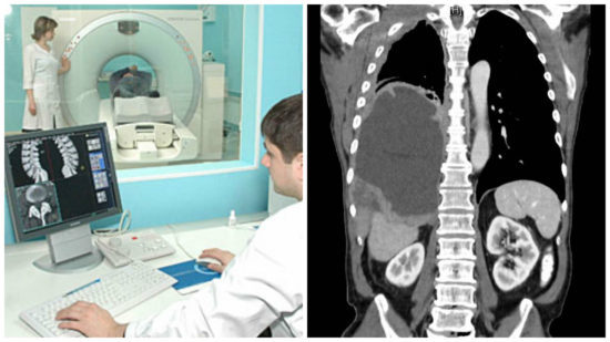 Компьютерная томография позвоночника при межпозвонковой грыже:  необходимость и вред процедуры 