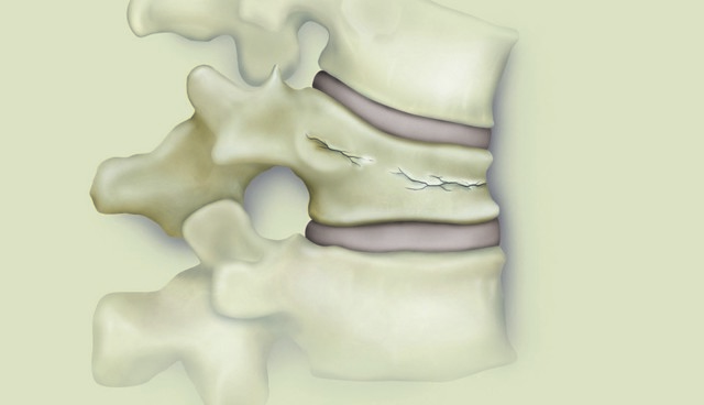 Компрессионный перелом позвоночника грудного, поясничного отдела: клинические проявления, принципы лечения и реабилитация