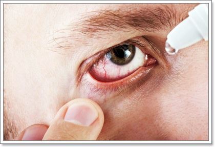 Конъюнктивит: причины и симптомы патологии, лечение воспаления глаз в домашних условиях