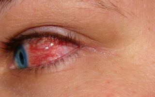 Конъюнктивит: причины и симптомы патологии, лечение воспаления глаз в домашних условиях