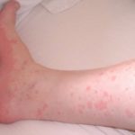 Контактная аллергия: причины возникновения реакции, специфические симптомы и методы лечения