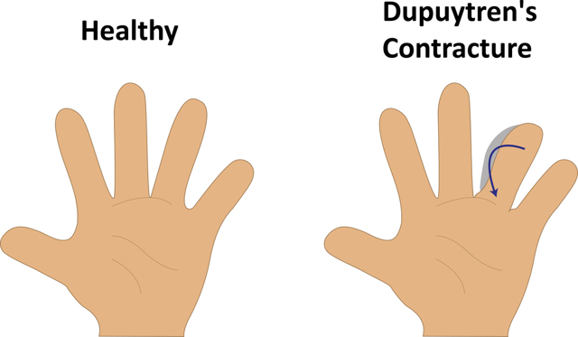 Контрактура Дюпюитрена: предрасполагающие факторы, типичные признаки, диагностика и тактика лечения