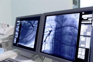Коронарография сосудов сердца: разновидности диагностики, показания к проведению, возможные последствия