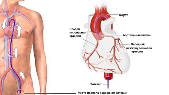 Коронарография сосудов сердца: разновидности диагностики, показания к проведению, возможные последствия